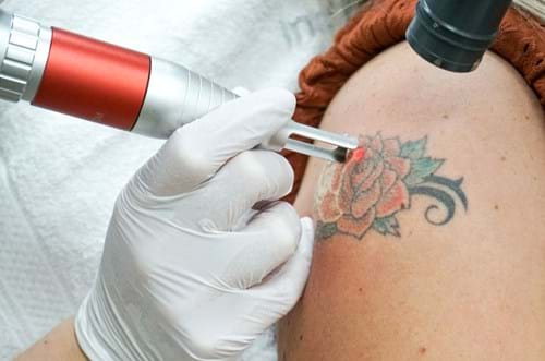Tattoo Verwijderen Assen