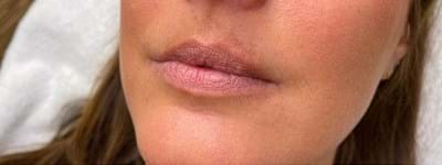 Lipfillers 2 (1)
