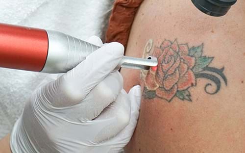 Tattoo Verwijderen Assen