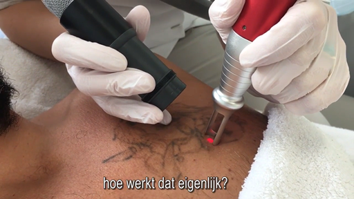 Hoe werkt tattoo verwijderen
