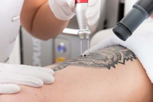 Tattoo Laseren Zeist (1)