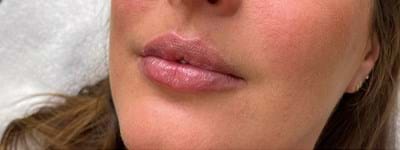 Lipfillers (1)